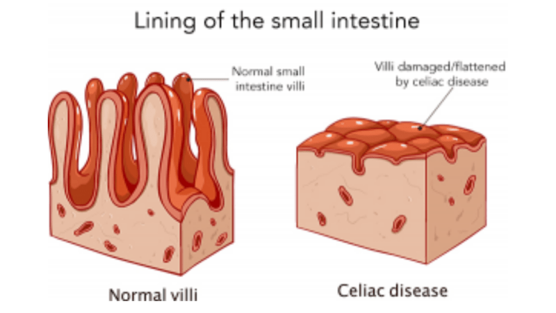 Does celiac disease cause cancer?