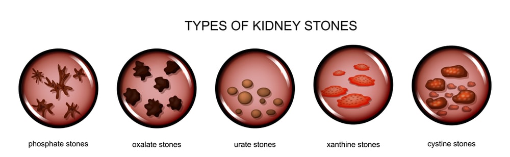 What is kidney stone pain like, Kidney stone, 7 Quick Guide To Know What is kidney stone pain like, kidneys, COVID-19, types of kidney stones, location of kidneys, what is a kidney stone,