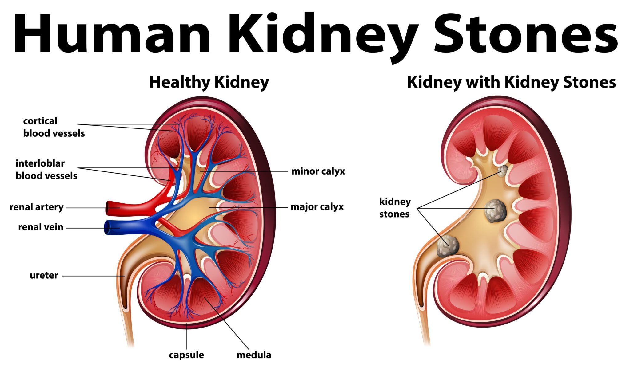 7-quick-guide-to-know-what-is-kidney-stone-pain-like-turn-to-be-healthy