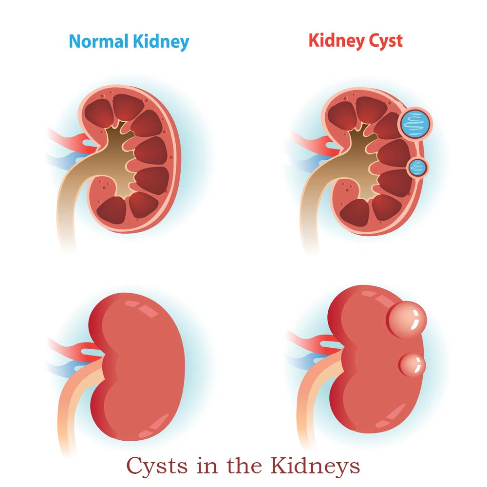 Kidney cyst is usually small fluid-filled sacs that grow in your kidney, which typically harmless and rarely cause symptoms. You may ask, "What are the symptoms of cysts in the kidneys?" Whenever the cyst becomes more significant, the more likely it will start presenting issues. Doctors don't understand yet why kidney cysts are there, hoping they will discover it soon. why do my kidneys hurt at night, kidney pain, kidneys hurt, Kidneys, Kidney Failure, Kidneys Symptoms, Why do my Kidneys Hurt When I Wake up, kidney disease, kidney health, kidney transplant, kidney warrior, diabetes, dialysis, kidney stones, kidney donor, chronic illness, kidney disease awareness, heart disease, chronic kidney disease, organ donation, cancer, nephrology, kidney awareness, kidney diet, kidney cancer, kidney problems, kidney care, fitness, heart attack, Back Pain, Kidney Traumas, Renal Obstructions, Renal Tumors, kidney Cysts, 