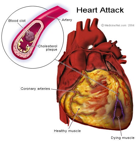"Kidney failure after heart attack" is developing top searches in search engines, which means there are more patients who got a severe concern about it. It is called a kidney attack. Generally, the heart and kidney are interconnected. If one organ damage, it will hardly affect another organ. alternative treatment, Anaemia, Asymptomatic Proteinuria, Ayurveda, cancer, cholesterol, chronic illness, COVID-19, Cutaneous infection, diabetes, Diabetic nephropathy, dialysis, diet plan, Dry skin, fitness, Glomerulus, Half Nails, healthy lifestyle, Heart and kidney failure symptoms, heart disease symptoms, Hematuria Syndrome, High blood pressure, How Does Diabetes Cause Kidney Disease, hypertension, Itching, kidney cancer, kidney care, kidney Cyst, kidney disease, kidney disease symptoms, kidney donor, kidney health, Kidney stone, kidney transplant, kidneys, location of kidneys, Lump in your belly, Nephrogenic, nephrology, Non-melanoma skin cancer, oral mucosal, Pigmentary Changes, Pruritus, Purpura, skin conditions, Skin discoloration, Symptoms of Kidneys not Filtering, types of kidney stones, what is a kidney stone, What is kidney stone pain like, Xerosis, heart attack, heart, heart disease, heart health, stroke, diabetes, health, cardiology, cardia car rest, healthy lifestyle, covid, cancer, healthy, blood pressure, cholesterol, heart attack survivor, heart healthy, high blood pressure, hypertension, cardio, 