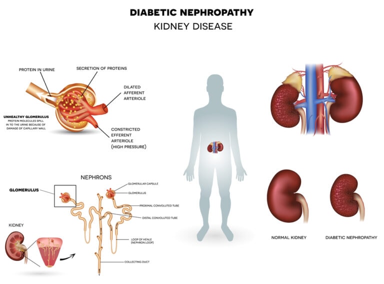 10 Free Tips How Does Diabetes Cause Kidney Disease Turn To Be Healthy