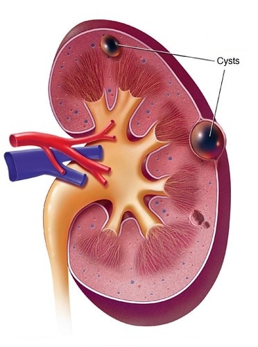 Kidney cyst is usually small fluid-filled sacs that grow in your kidney, which typically harmless and rarely cause symptoms. You may ask, "What are the symptoms of cysts in the kidneys?" Whenever the cyst becomes more significant, the more likely it will start presenting issues. Doctors don't understand yet why kidney cysts are there, hoping they will discover it soon. why do my kidneys hurt at night, kidney pain, kidneys hurt, Kidneys, Kidney Failure, Kidneys Symptoms, Why do my Kidneys Hurt When I Wake up, kidney disease, kidney health, kidney transplant, kidney warrior, diabetes, dialysis, kidney stones, kidney donor, chronic illness, kidney disease awareness, heart disease, chronic kidney disease, organ donation, cancer, nephrology, kidney awareness, kidney diet, kidney cancer, kidney problems, kidney care, fitness, heart attack, Back Pain, Kidney Traumas, Renal Obstructions, Renal Tumors, kidney Cysts, Polycystic kidney disease, 